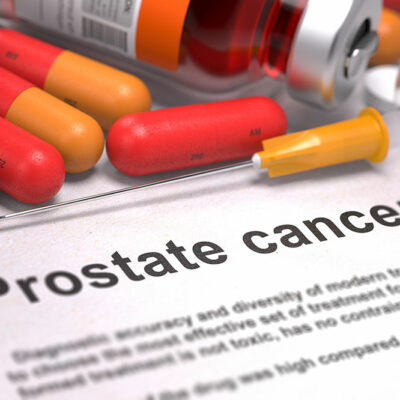 4 Causes of Prostate Cancer