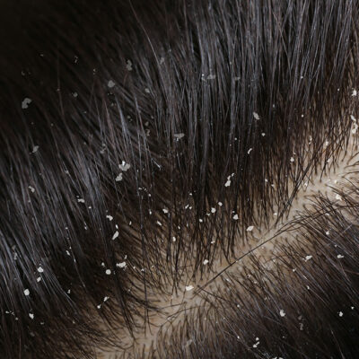 4 Effective Home Remedies for Dandruff