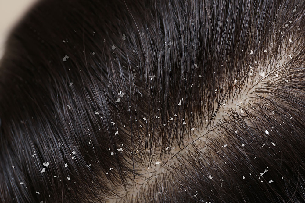 4 Effective Home Remedies for Dandruff