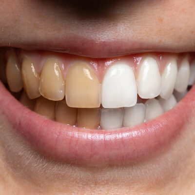 4 Ways to Get Rid of Yellow Teeth