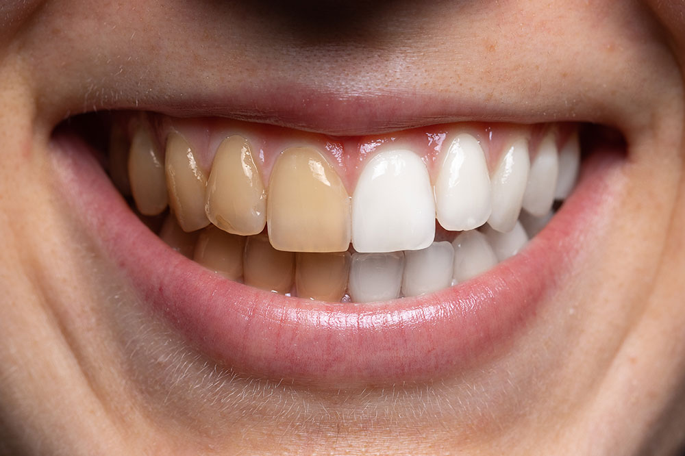 4 Ways to Get Rid of Yellow Teeth