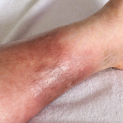 5 Ways to Manage DVT Naturally