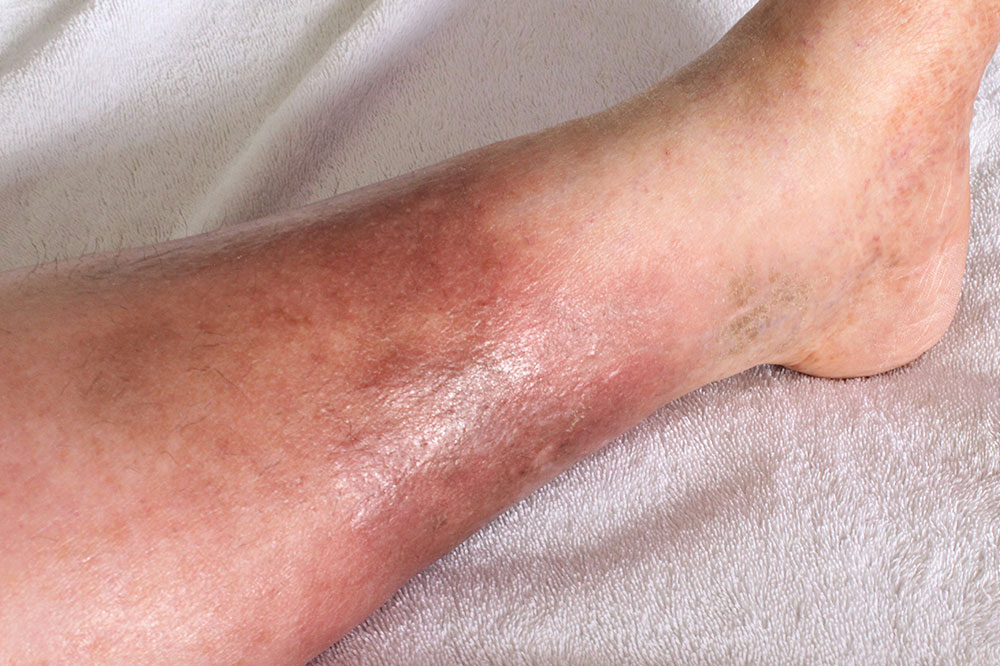 5 Ways to Manage DVT Naturally