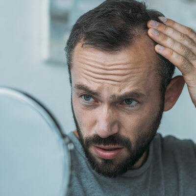 6 Hair Loss Treatments for Men