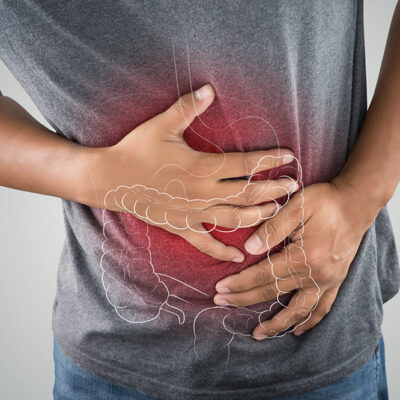 The Stages of Colon Cancer
