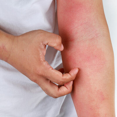 The Worst Cities for Atopic Dermatitis and Eczema Patients to Live