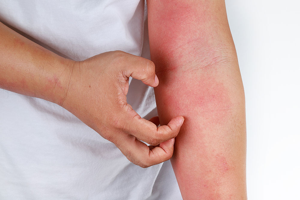 The Worst Cities for Atopic Dermatitis and Eczema Patients to Live