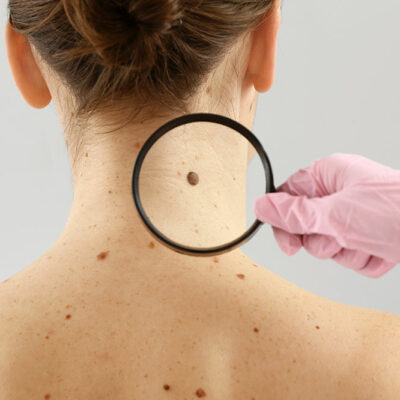 The Types and Signs of Melanoma
