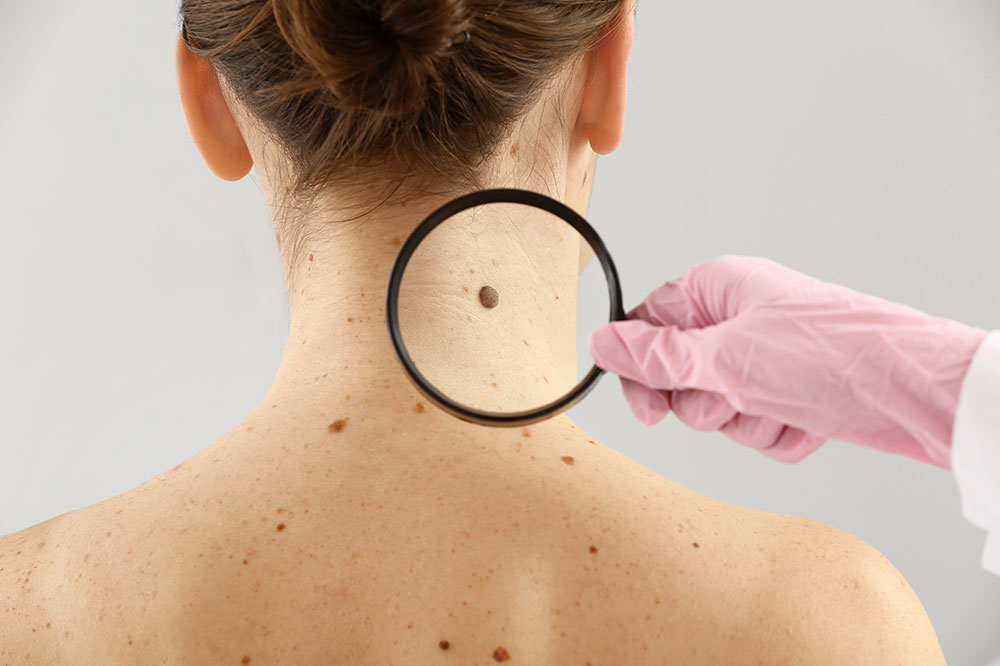 The Types and Signs of Melanoma