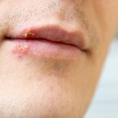 Triggers and Causes for Cold Sores