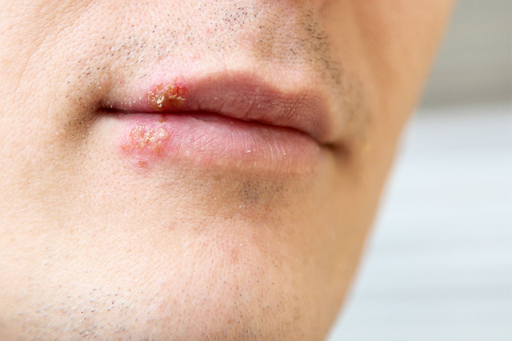 Triggers and Causes for Cold Sores